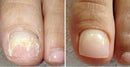 Pies de Oro - Tratamiento Anti Hongos 100% Natural